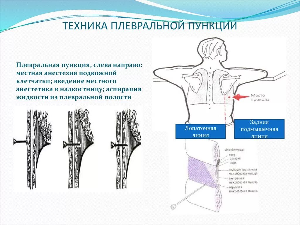 Техника выполнения плевральной пункции. Пункция грудной клетки при гидротораксе. Пункция плевральной полости техника. Техника проведения плевральной пункции при пневмотораксе.
