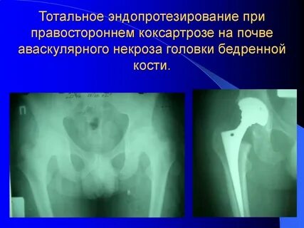 Инвалидность при коксартрозе