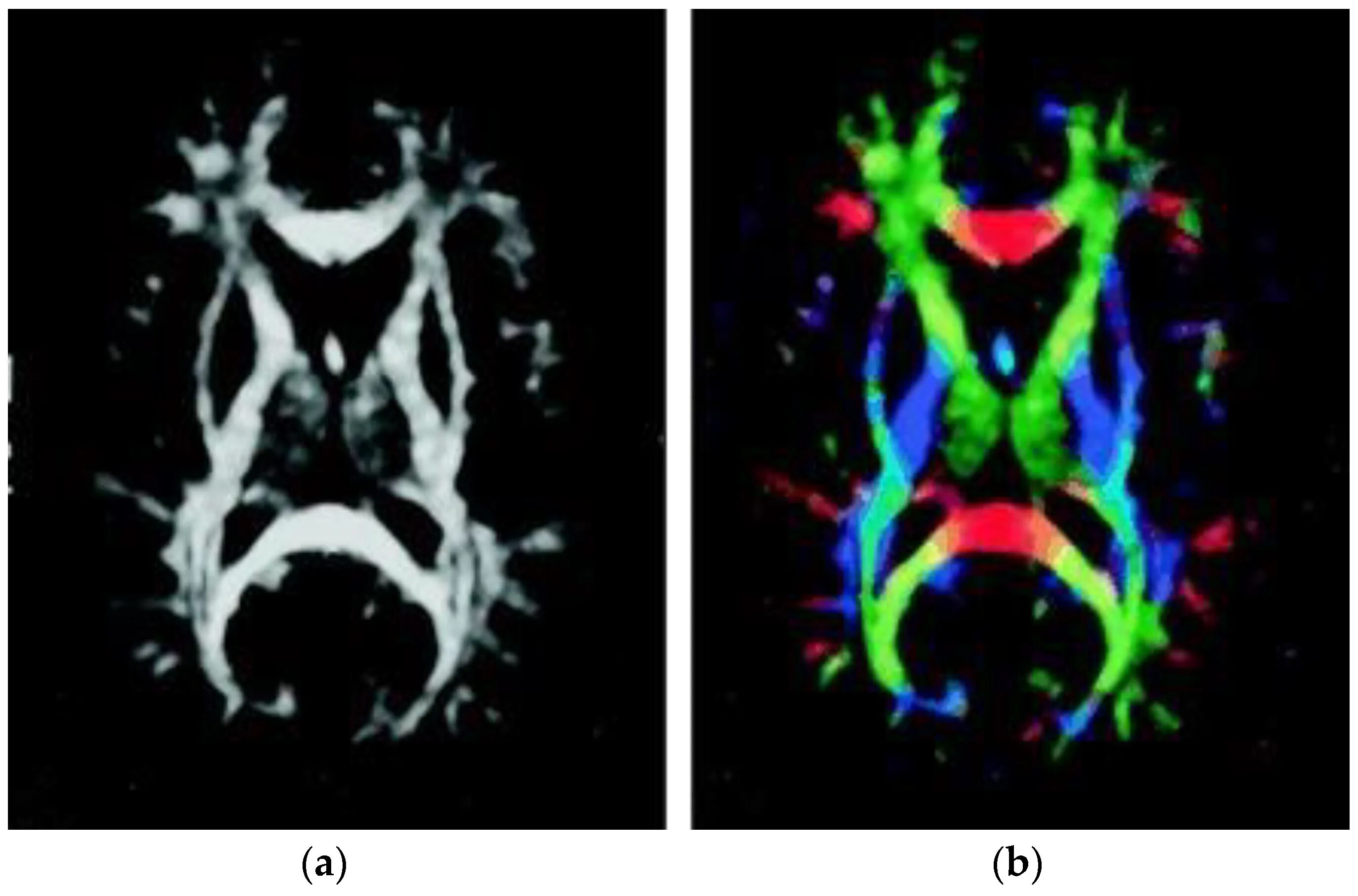 Диффузионно-тензорная мрт. Диффузионная спектральная томография. Diffusion Tensor Imaging (DTI). Мрт + диффузное тензорное изображение.