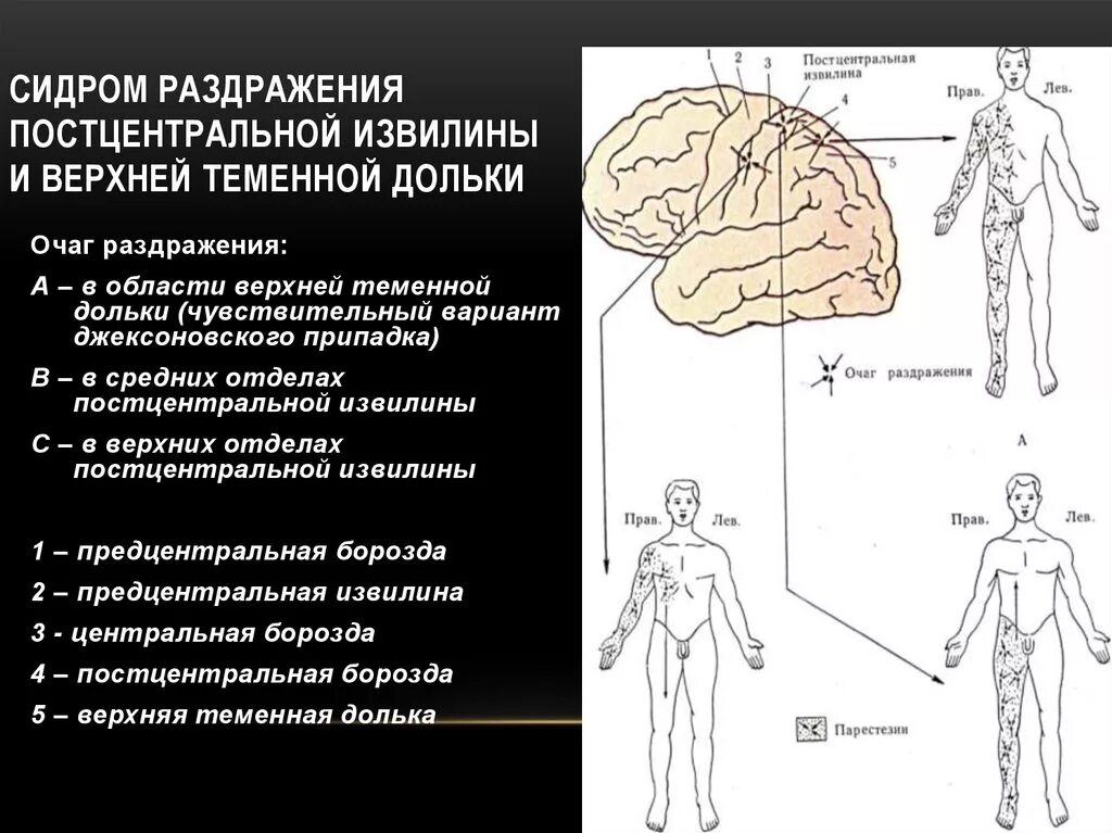 Раздражение коры головного мозга. Джексоновская эпилепсия очаг поражения. Синдромы поражения постцентральной извилины. Синдром поражения прецентральной извилины. Симптомы поражения прецентральной извилины головного мозга..