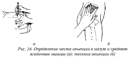 Как колоть железо внутримышечно. Внутримышечная инъекция в плечо техника. Техника внутримышечной инъекции в дельтовидную мышцу. Место введения внутримышечной инъекции в дельтовидную мышцу. Место инъекции в плечо.