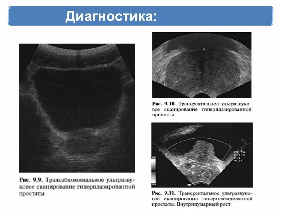 Гиперплазия простаты что это такое