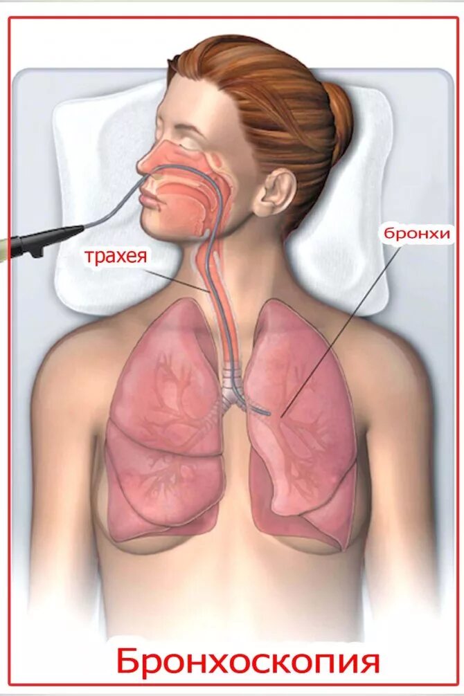 Пневмония бронхоскопия. Саркоидоз бронхоскопия. Бронхоскопия трахеобронхоскопия. Много воды в легких