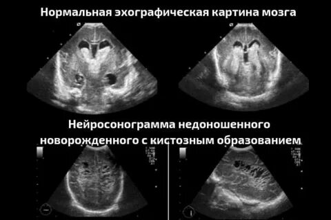 Нейросонография где