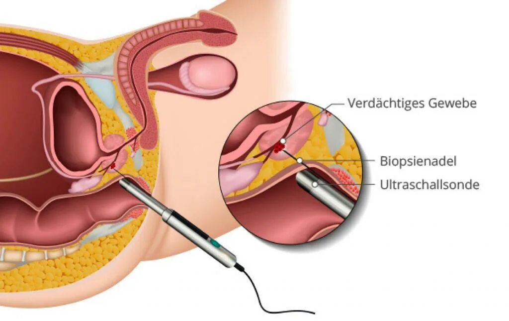 Как берут биопсию у мужчин. Трансректальное УЗИ предстательной железы. Пункционная биопсия предстательной железы. Трепан биопсия предстательной железы.