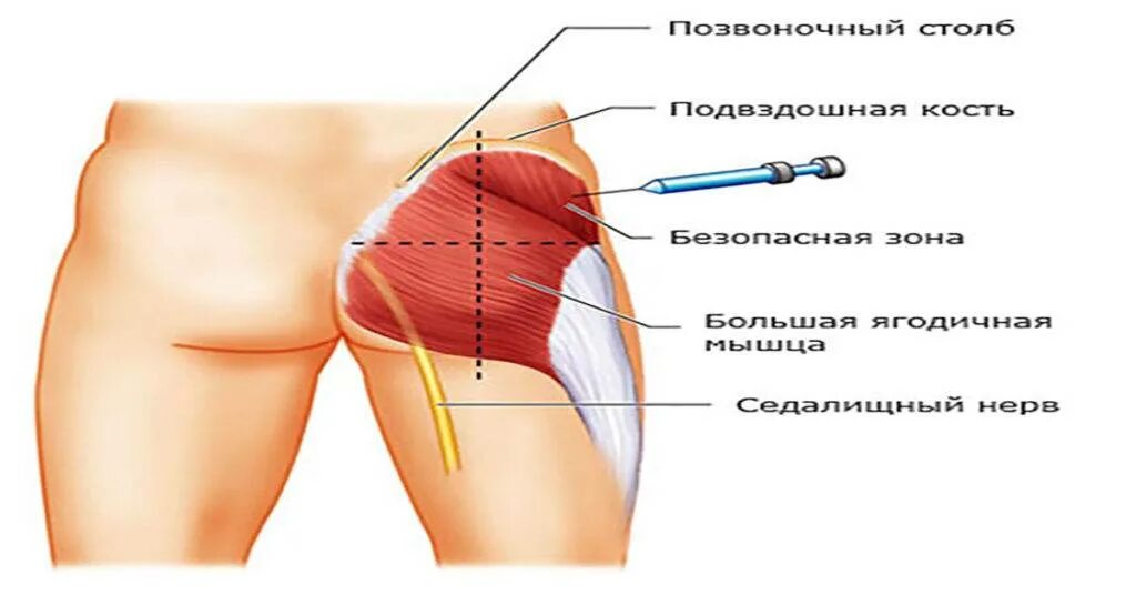 Укол внутримышечно в ягодицу. Схема как правильно ставить уколы в ягодицу. Инъекция внутримышечно в ягодицу.