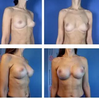 Увеличение груди анатомическими имплантами 325 мл. 