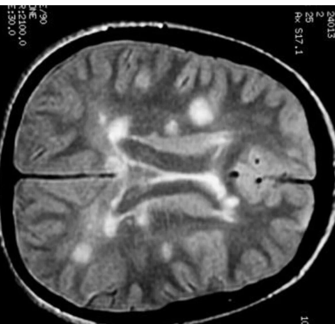 Демиелинизация головного мозга мрт. Очаги демиелинизации на мрт. Очаги демиелинизации головного мозга на мрт. Демиелинизация мозга на кт. Демиелинизация головного