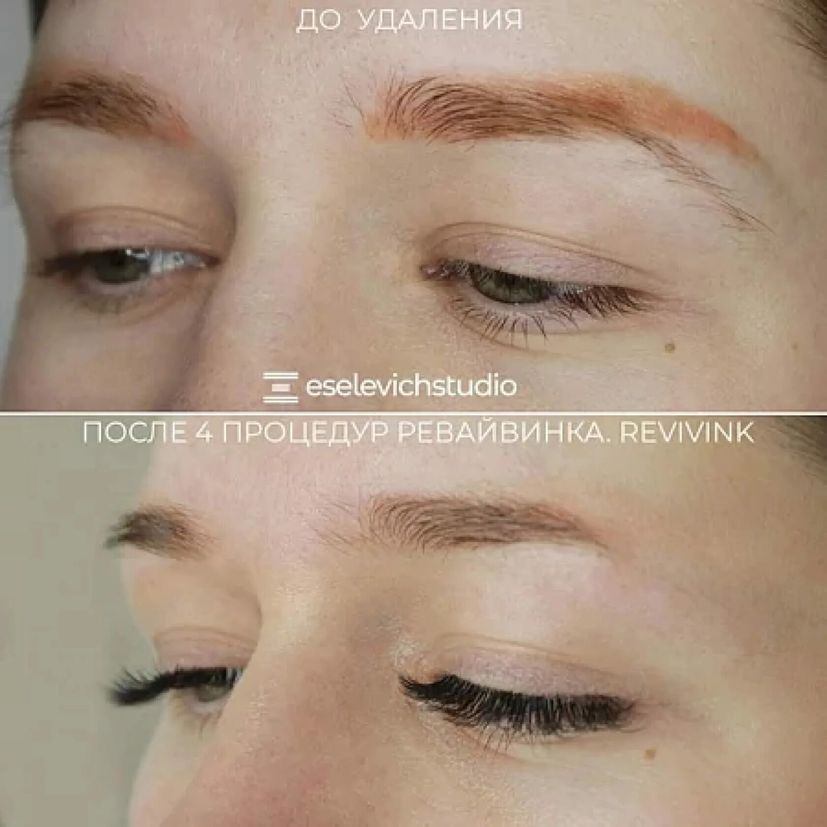 брови ревайвинг что это такое. ревайвинг. ревайвинг. белый татуаж. ревайвинг для удаления татуажа гипоаллергенные.