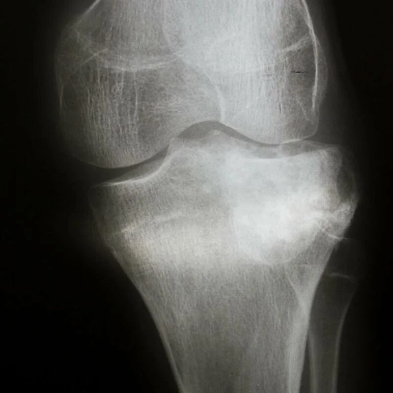 Сустав 1а. Гонартроз коленного сустава 2. Гонартроз 3 степени коленного сустава рентген. Артроз коленных суставов (гонартроз). Гонартроз 1 степени коленного сустава что это такое.