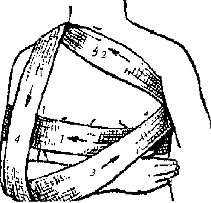Повязка на руку схема. Повязка Дезо бинтом. Десмургия повязка Дезо. Колосовидная повязка Дезо. Перевязка плеча повязка Дезо.