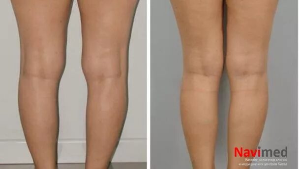 Жировой валик над коленями. Упражнения от жира на коленях. Внутренняя сторона коленей убрать. Внутренняя сторона коленей убрать. Липосакция и подтяжка бедер.