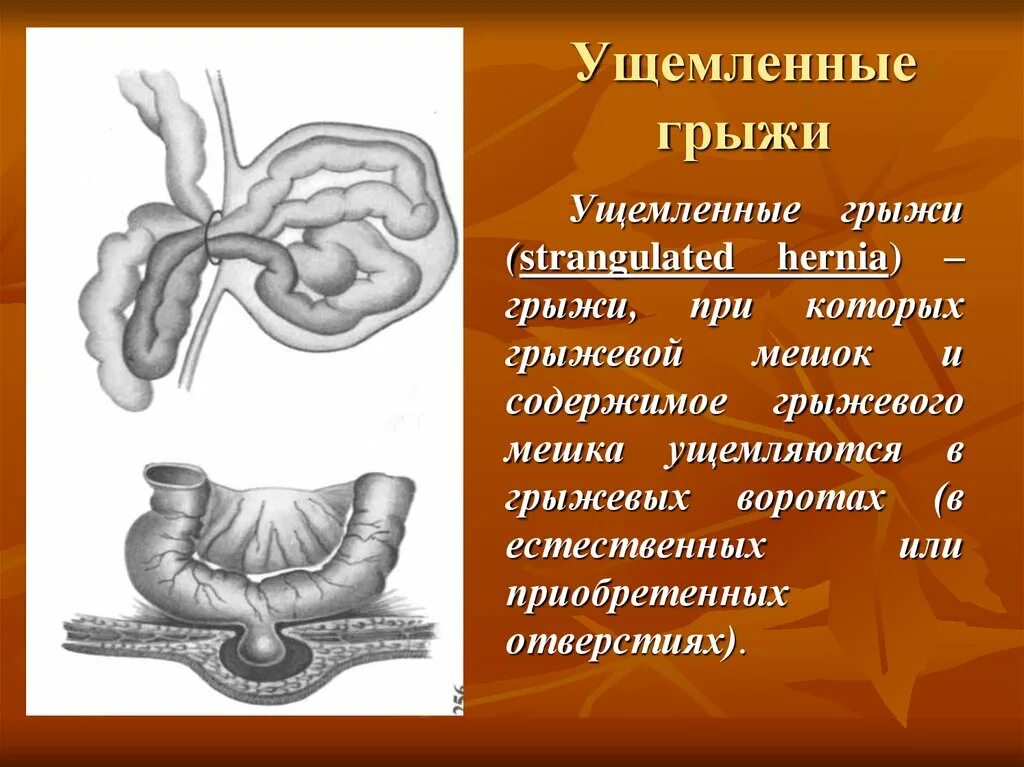 Ущемленная грыжа помощь. Ущемленные наружные грыжи. Клинические проявления ущемленной грыжи.