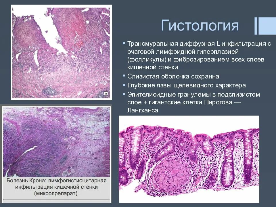 Лимфоидная инфильтрация что это. Болезнь крона гистология. Гранулема при болезни крона гистология. Эпителиоидная гранулема при болезни крона. Гистология при болезни крона.
