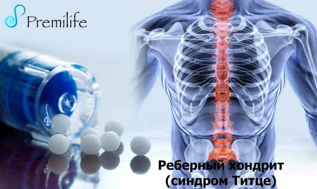 Синдром титце. Реберный хондрит титце. реберный синдром титце. синдром титце грудная клетка.