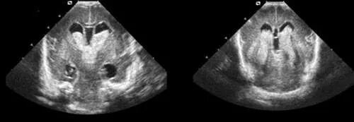 УЗИ головного мозга нейросонография. Гидроцефалия нейросонография. Нейросонография кровоизлияние УЗИ. УЗИ нейросонография новорожденных.