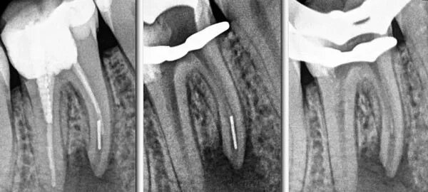 Временное пломбирование каналов зуба. Отлом эндодонтического инструмента в канале корня. Перелечивание корневых каналов.