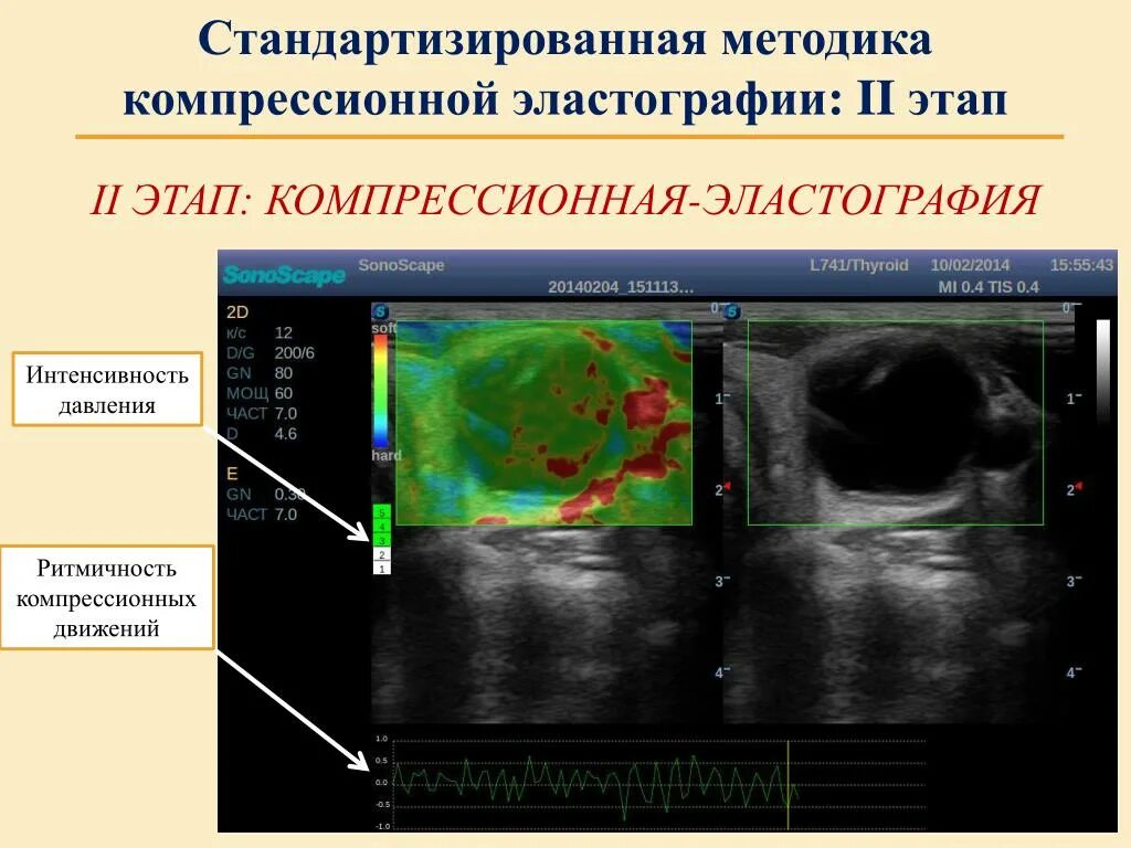 Эластография щитовидной железы что это. Эластография сдвиговой волны печени. Компрессионная эластография щитовидной железы. Эластометрия сдвиговой волной печени. Эластометрия печени протокол УЗИ.