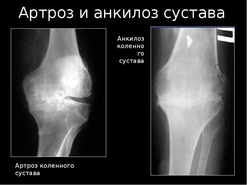 Анкилоз тазобедренного сустава. Костный анкилоз в суставе. анкилозирование сустава это. фиброзно-костный анкилоз. костный анкилоз коленного сустава.