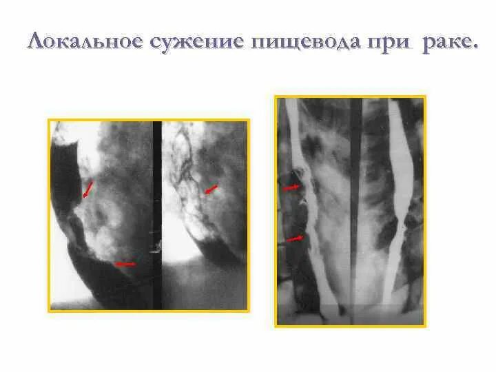 Сужение пищевода симптомы. Стриктура пищевода рентген. Декомпенсированный стеноз пищевода. Стеноз пищевода рентген. Врожденный стеноз пищевода.