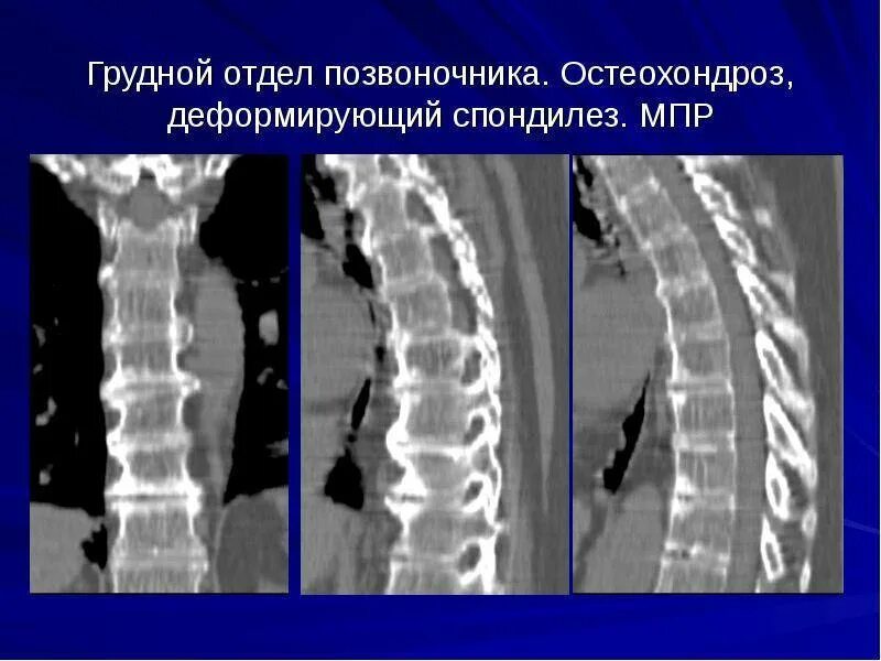 Деформирующий спондилез рентген. Деформирующий спондилоартроз на кт. Остеохондроз деформирующий спондилез. Деформирующий спондилез l2 l5. Картина спондилеза