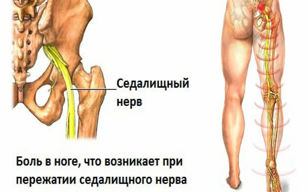 Нервно седалищный нерв. Ишиас воспаление седалищного нерва. Невропатия седалищного нерва клиника. Защемление седалищного нерва анатомия.