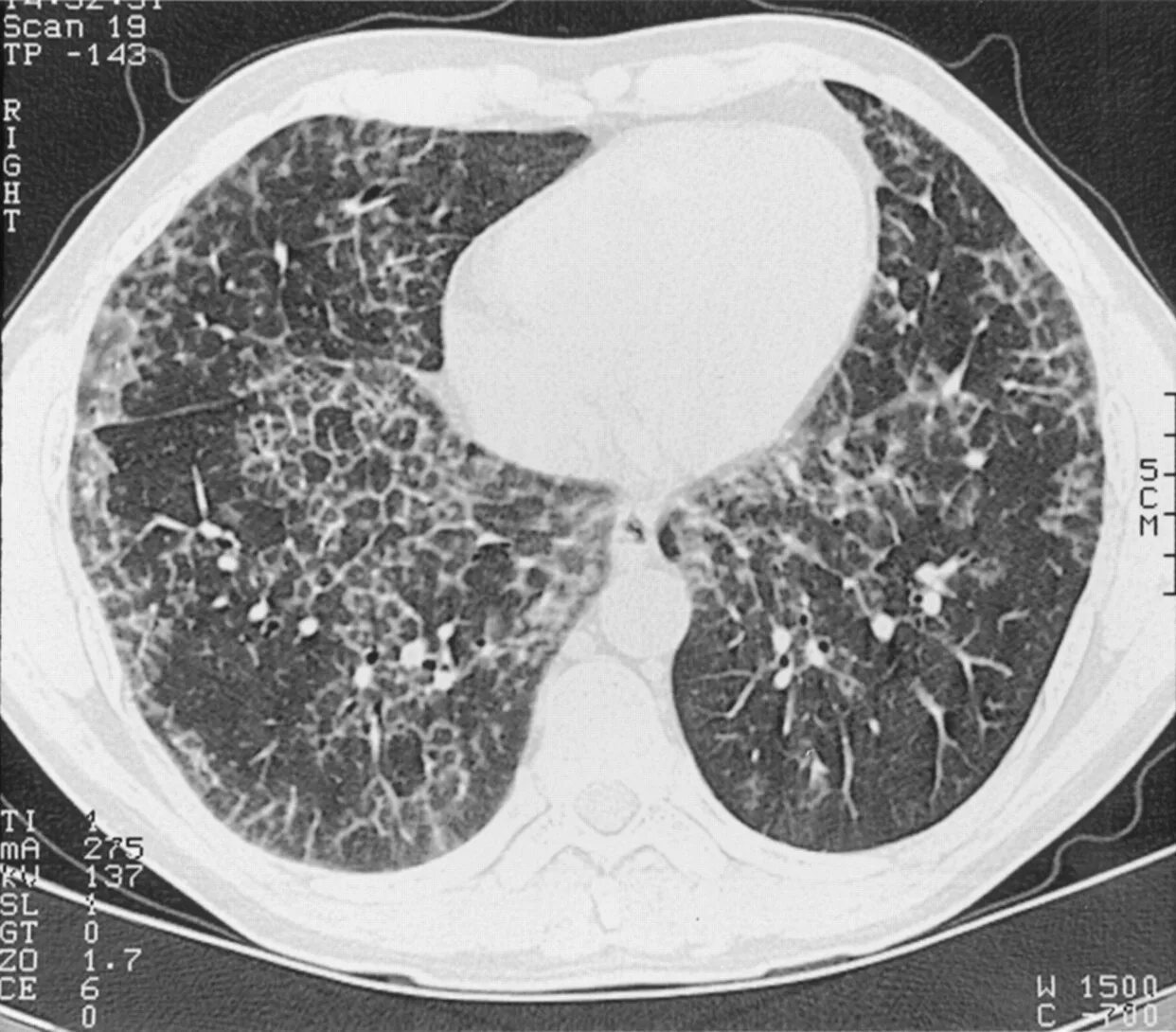 Альвеолярный протеиноз легких на кт. Pulmonary alveolar Proteinosis. Булыжной мостовой кт легких. Легочный альвеолярный протеиноз кт.