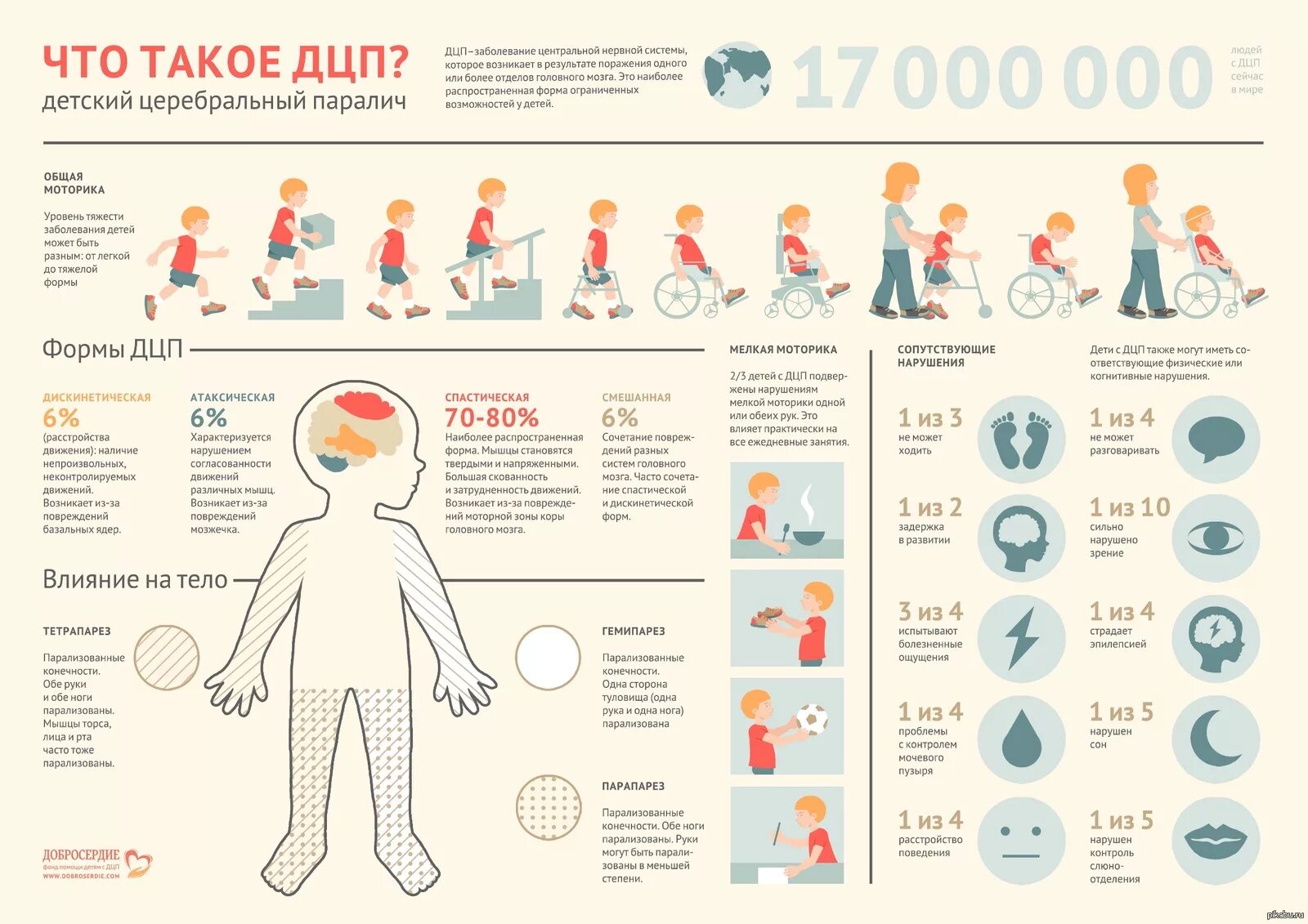 Дцп является. ДЦП В легкой форме симптомы у детей до года. ДЦП У детей симптомы в 1. Лёгкая форма ДЦП признаки у детей. ДЦП В легкой форме симптомы у детей.