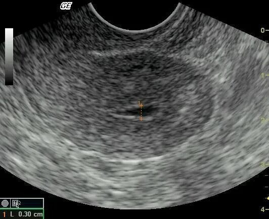 Серозометра шейки матки. Полип эндометрия серозометра что это такое. Полип полости матки на УЗИ.
