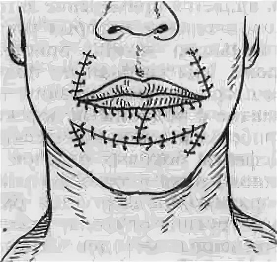 Операция нижней губы. Восстановительная хирургия ЧЛО. Пластика нижней губы по Блохину. Резекция нижней губы по Блохину. Восстановительные операции нижней губы.
