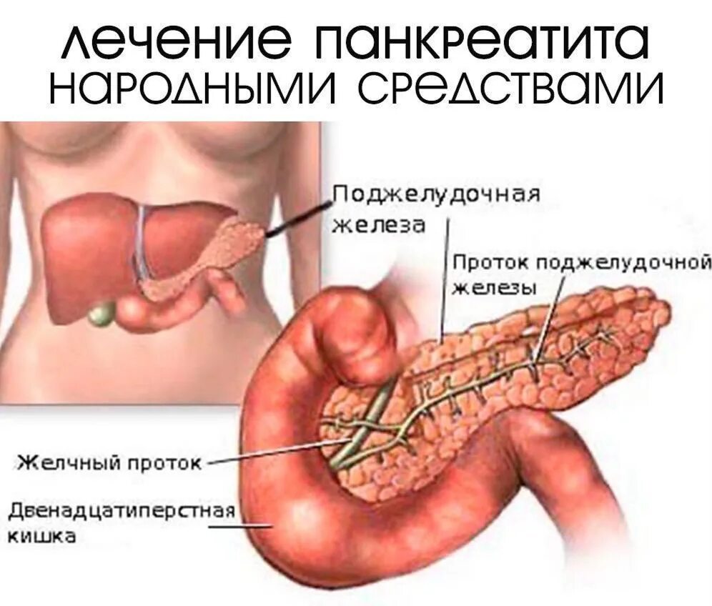 острый билиарный панкреатит. подострый панкреатит симптомы. панкреатит симптомы панкреатин. панкреатит желудка симптомы. болезнь хронический панкреатит поджелудочной железы.