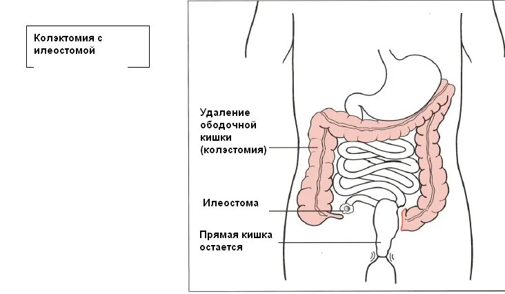 Вывести прямую кишку