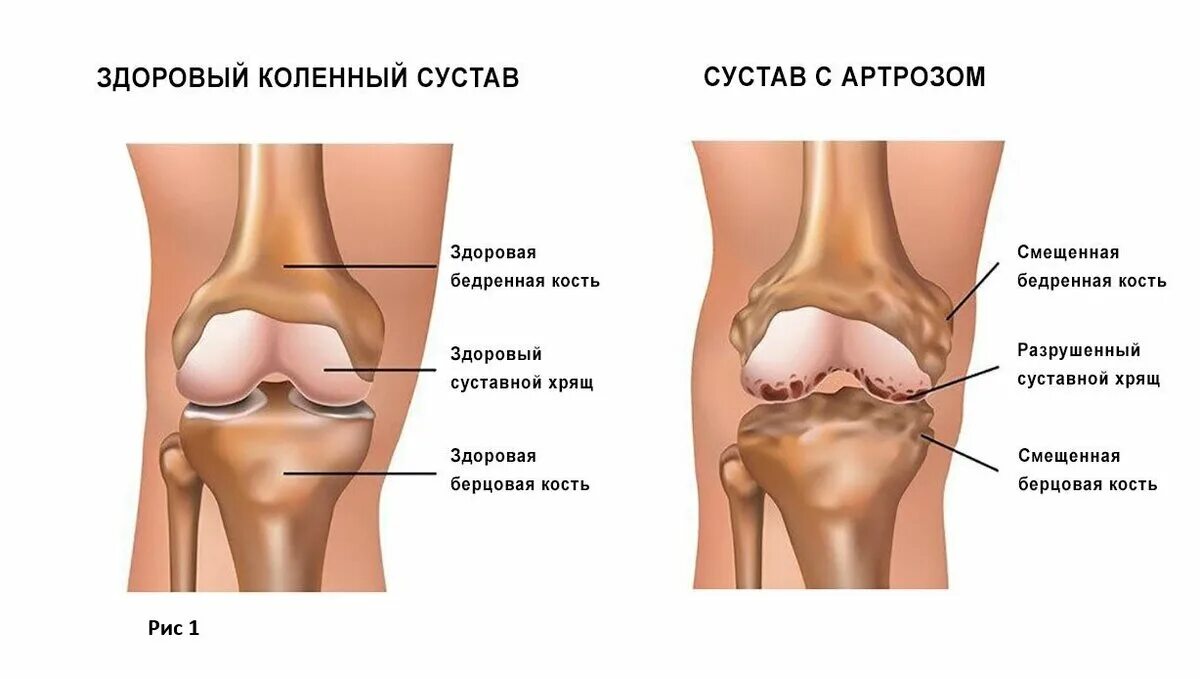 Суставной хрящ коленного сустава болит. Остеоартрит коленного сустава. Разрушение коленного сустава.