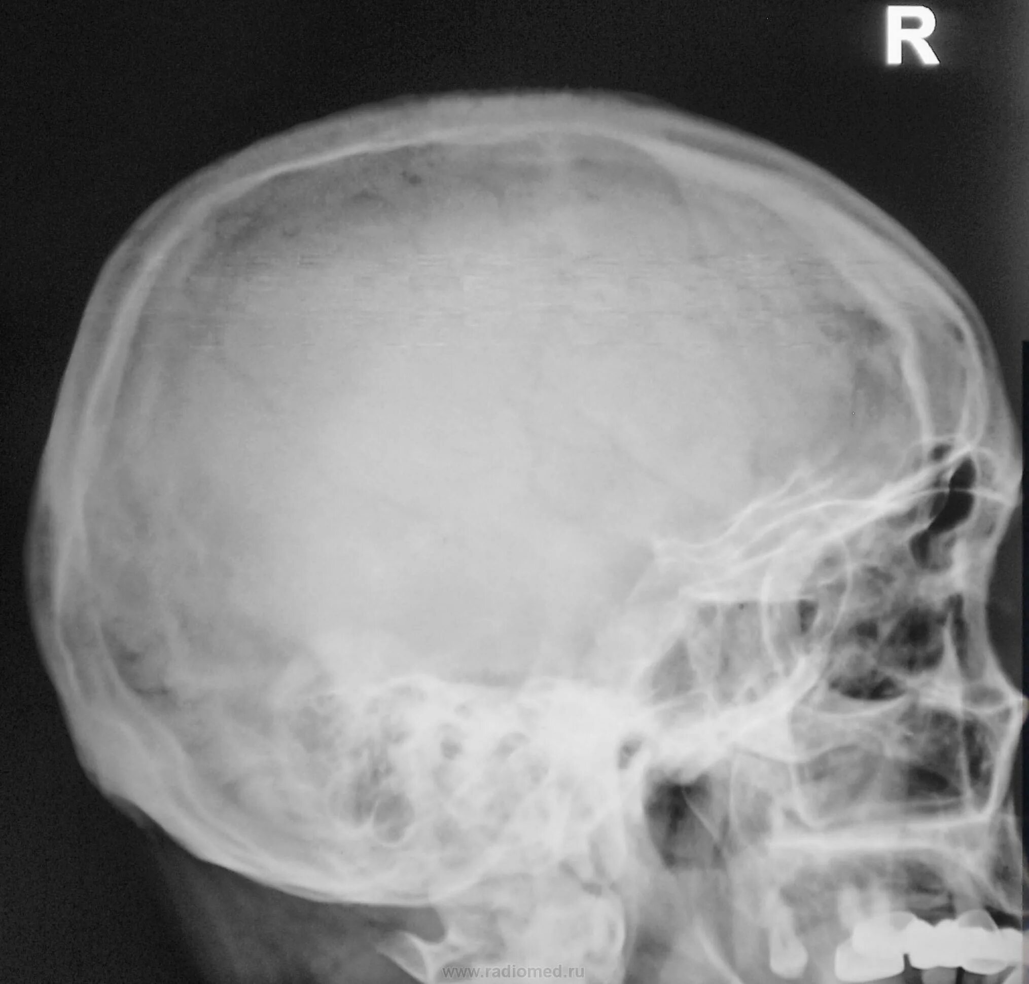 Рентгенограмма черепа норма. Кости черепа рентген норма. Краниограмма черепа боковая рентген. Трещина черепа у ребенка