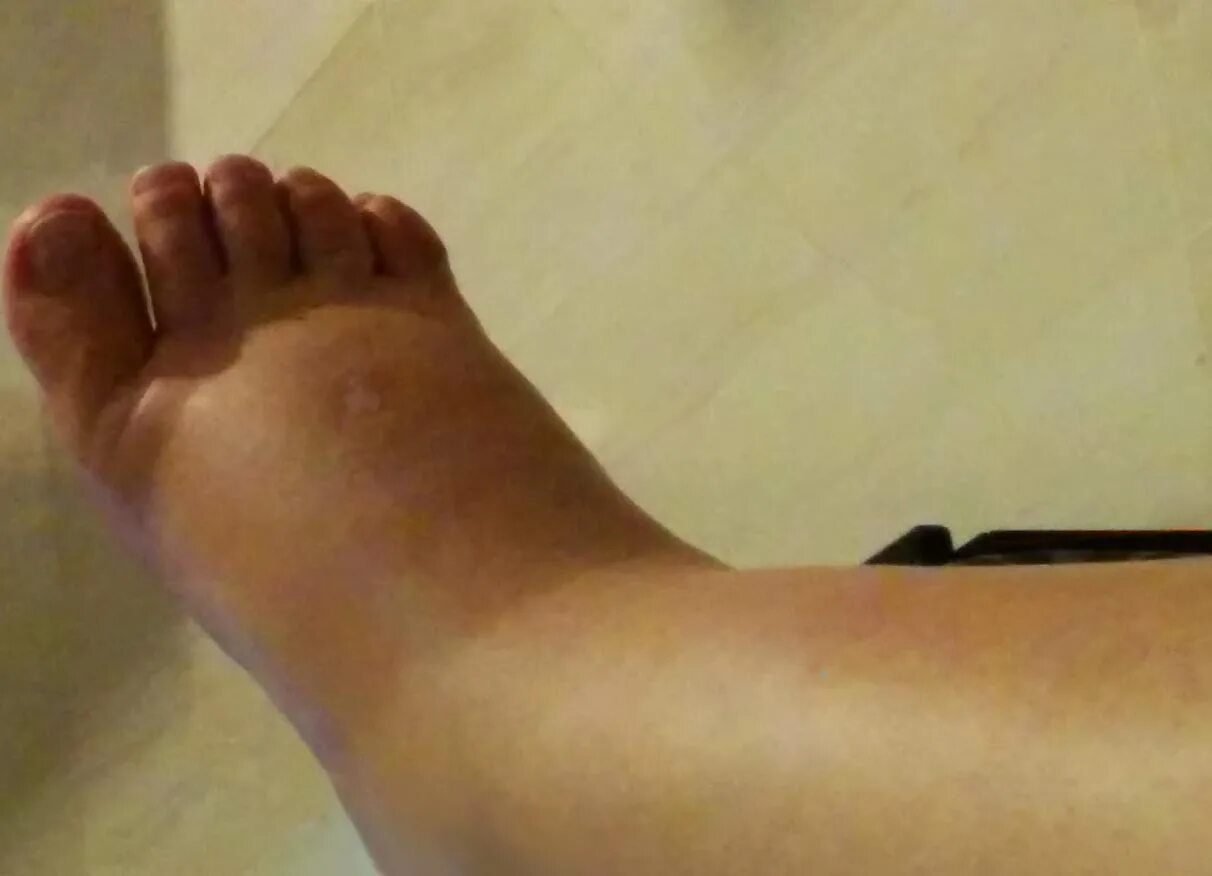 Отекли стопы как снять отек быстро Natural Solution for Swollen Feet: Parsley Tea