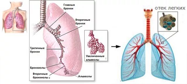 Токсический отек легких.