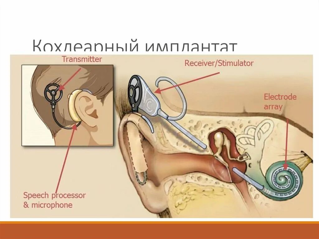 Операция на ухо на слух. Кохлеарная имплантация строение уха. Кохлеарный имплант слух. Кохлеарный имплант строение. Кохлеарный имплант рисунок.