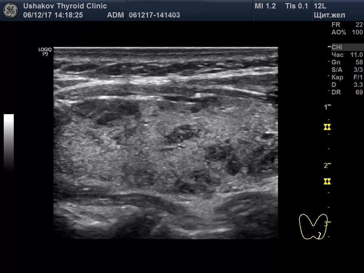 Диффузно -Узловой Зов УЗИ. УЗИ щитовидной железы зоб. Диффузно узловое образование