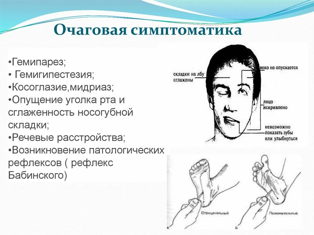 Сглажена носогубная складка. Сглаженность носогубной складки при инсульте. Гемипарез очаговая симптоматика.