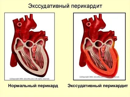 Перикардиальный выпот