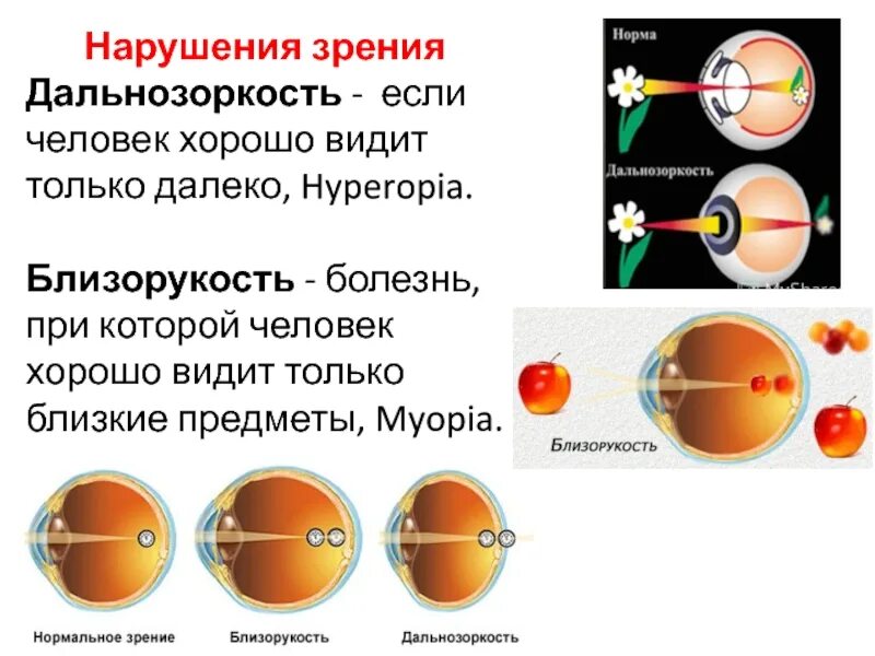 Причины возникновения дальнозоркости. Нарушение зрения дальнозоркость. Нарушение зрения близорукость дальнозоркость. Заболевание миопия. Зрительный анализатор дальнозоркость и близорукость.