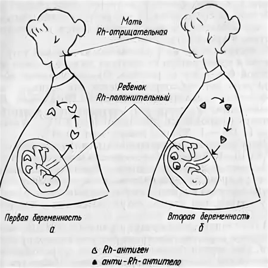 Резус прививка. Механизм развития резус конфликта схема. Гемолитическая болезнь плода схема. Гемолитическая болезнь плода механизм.