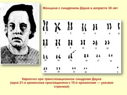 Кариотип транслокации