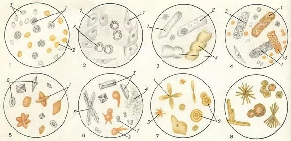 Лейкоциты и эритроциты в моче микроскопия. Элементы мочи. Организованный и неорганизованный осадок мочи. Микроскопия мочи лейкоциты и эритроциты. Организованный осадок мочи.