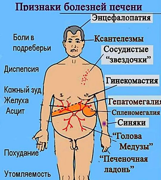 Колит печень. Ранние признаки цирроза печени. Симптомы церозапечент. Симптомы заболевания печени. Призники церроз печень.