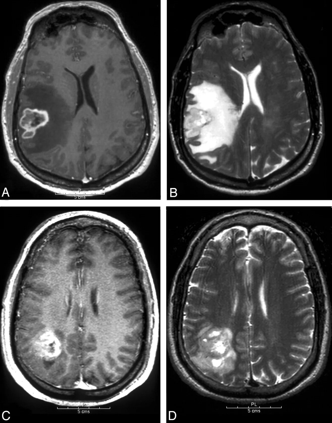 Мультифокальная глиобластома. Low Grade glioma мрт. Что такое глиома