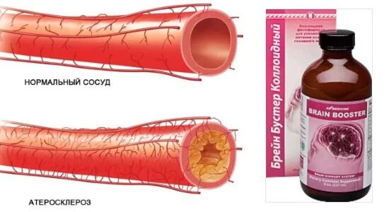 Атеросклероз головного мозга таблетки. Атеросклероз сосудов полового члена. Препараты для улучшения капилляров и вен.