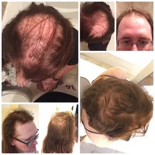 Hair regrowth from 3 months pre anything to 5 months HRT / 2 months finaste...