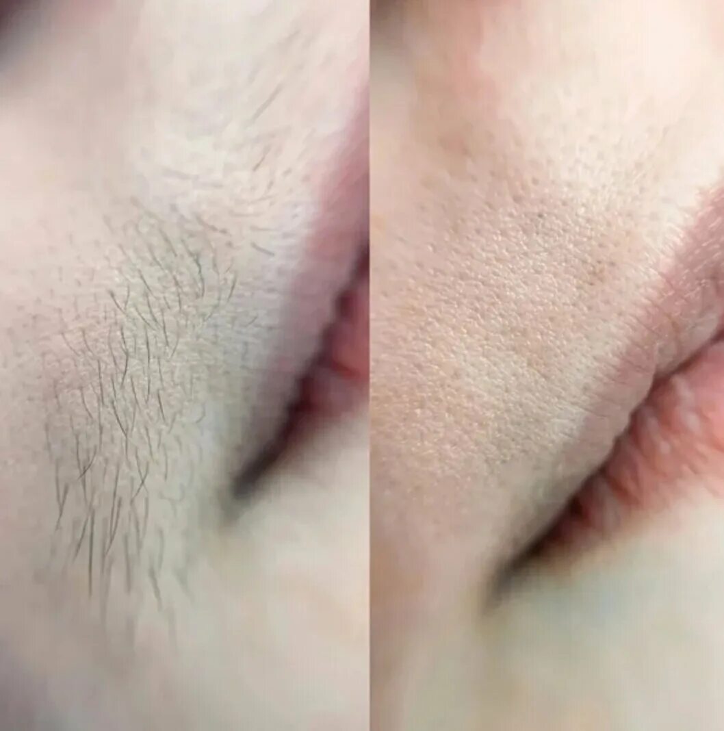 ухоженные губы. депиляция воском над верхней губой. депиляция верхней губы. лазерная эпиляция усики. лазерная эпиляция над верхней губой.