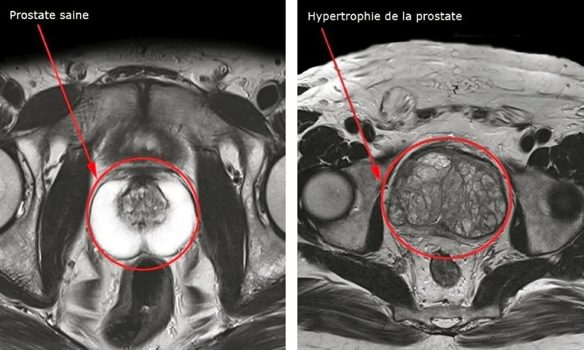 Кт органов таза у мужчин. Мрт предстательной железы. Магнитно-резонансная томографии (мрт) предстательной железы. Гиперплазия предстательной железы мрт. Мультипараметрическое мрт предстательной железы.